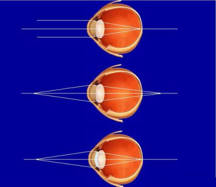 医生说孩子眼球不正常,医生诊断屈光不正是什么意思