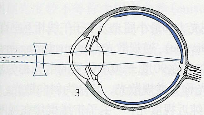 眼科医生检查后，说孩子眼睛“屈光不正”，是什么意思？