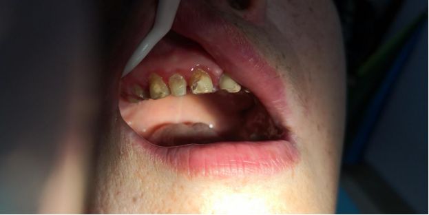 老掉牙怎么办吃什么可缓解,老掉牙什么意思