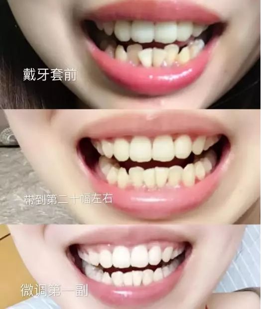 别人矫牙1万起,广州只要3960元!仅限2天