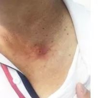 脖子突然一块红痒起泡,大人脖子上起了一片红色的颗粒