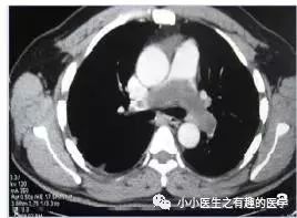 肺动脉分支充盈欠佳是肺栓塞吗,肺动脉缺损不可逆