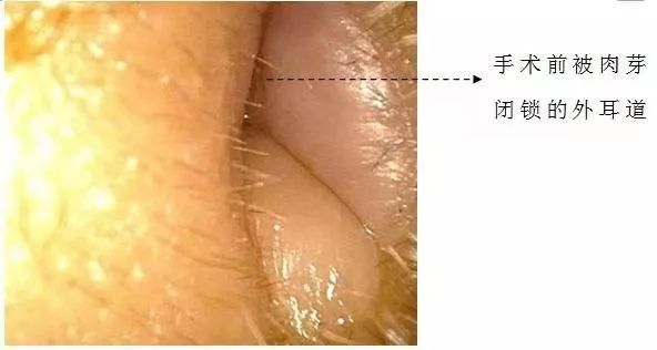 「提醒」20多岁姑娘耳屎总也掏不尽，结果在耳朵里发现了这东西...