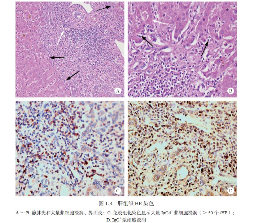 igg4疾病胆管炎会引起ca199升高吗,igg4相关性胰腺胆管炎
