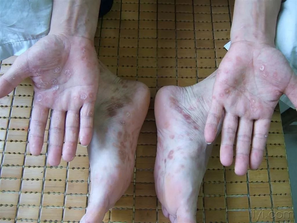 足癣冷知识,杏林微科普预防秋燥的方法