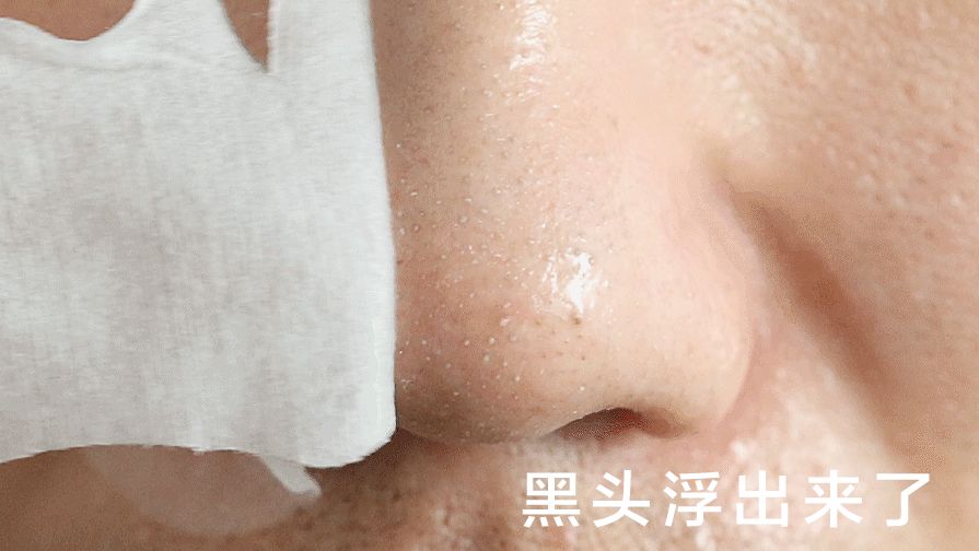 超级黑头正确处理方法,黑头别膨胀3招把你刷光光