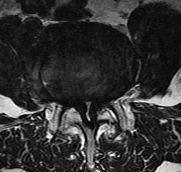 一分钟带你了解腰椎狭窄,椎管狭窄症知识大全