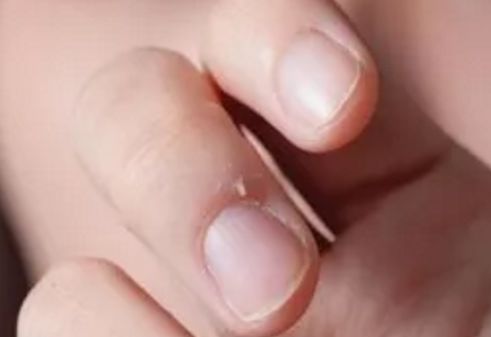 一个没注意,手指倒刺变截指!这个动作千万别再做了!