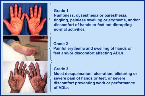 靶向药化疗对人体危害多大,肿瘤化疗毒副作用有哪些