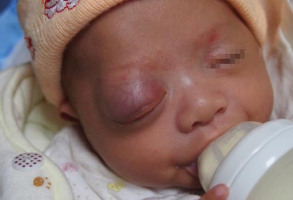 宝宝身上起红点当心这些皮肤病,婴儿皮肤起小红点一定是血管瘤吗