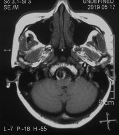 椎动脉夹层动脉瘤的最佳治疗方法,椎基底动脉夹层动脉瘤治疗方法