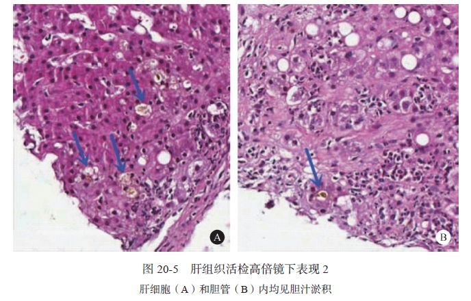 Zieve综合征1例|肝脏疾病疑难与经典病例(第四辑)