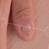 灰指甲美甲处理,灰指甲霉菌感染致癌