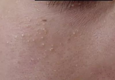 脂肪粒的由来,杏林微科普帮您认识各类头晕