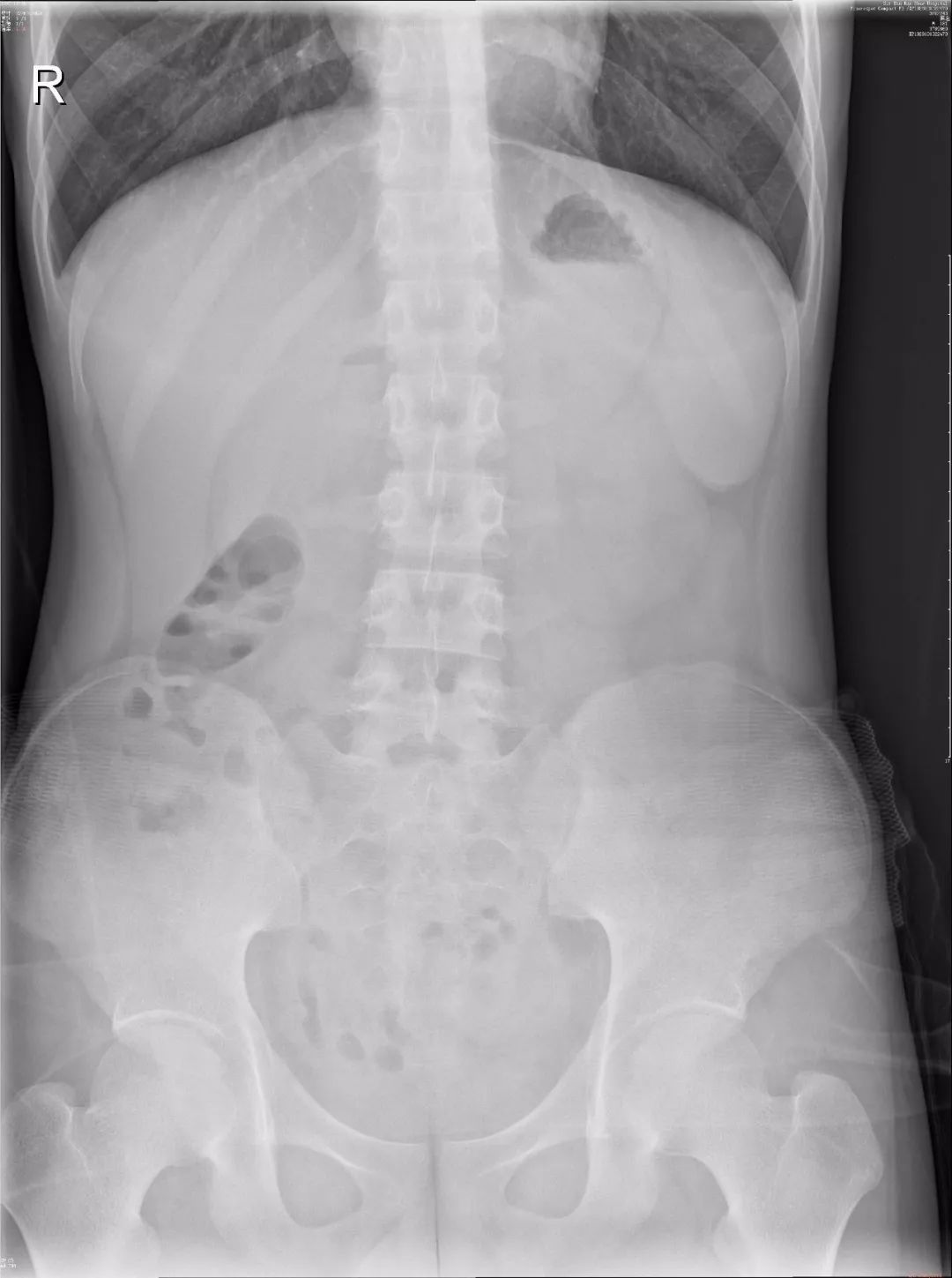 急诊科常见急腹症观察,腹部急诊影像大全值得收藏