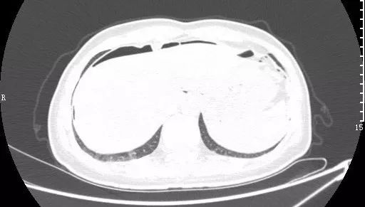 急诊科常见急腹症观察,腹部急诊影像大全值得收藏