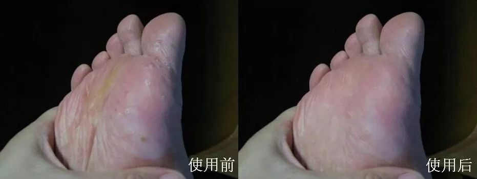 治脚气干裂起皮用什么药膏,有这个方子来治脚气就不怕复发