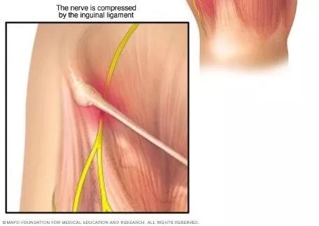 大腿外侧麻木是神经病变吗,股内侧皮神经受损大腿后侧麻木