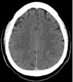 Reco特约·第10期｜国产组合助力取栓“一把通”——Ewata球囊导引导管联合Reco支架取栓分享