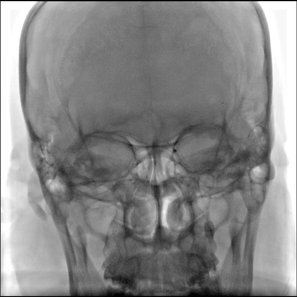 Reco特约·第10期｜国产组合助力取栓“一把通”——Ewata球囊导引导管联合Reco支架取栓分享