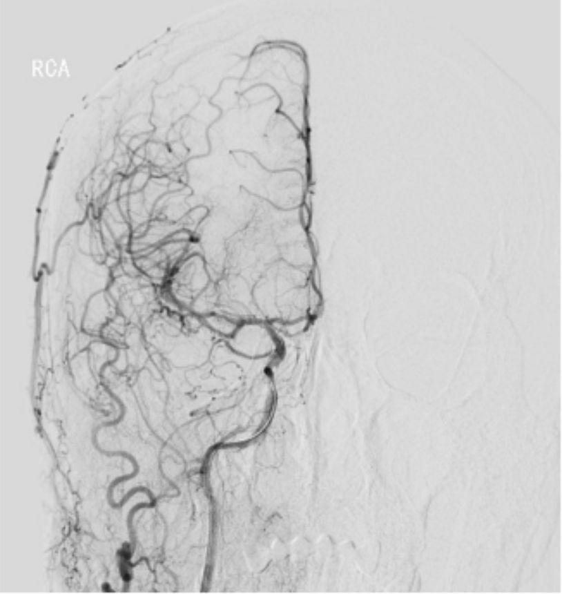 颈内动脉闭塞先进治疗,颈内动脉闭塞开通术病例讨论