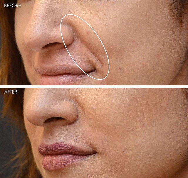 法令纹又黑又长,法令纹又深又长好吗