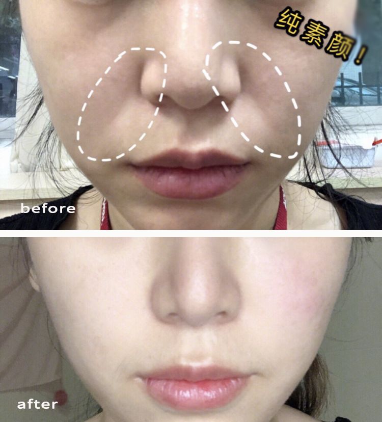 眉间纹和法令纹除皱针能去掉吗,嘴角纹法令纹抬头纹国货推荐