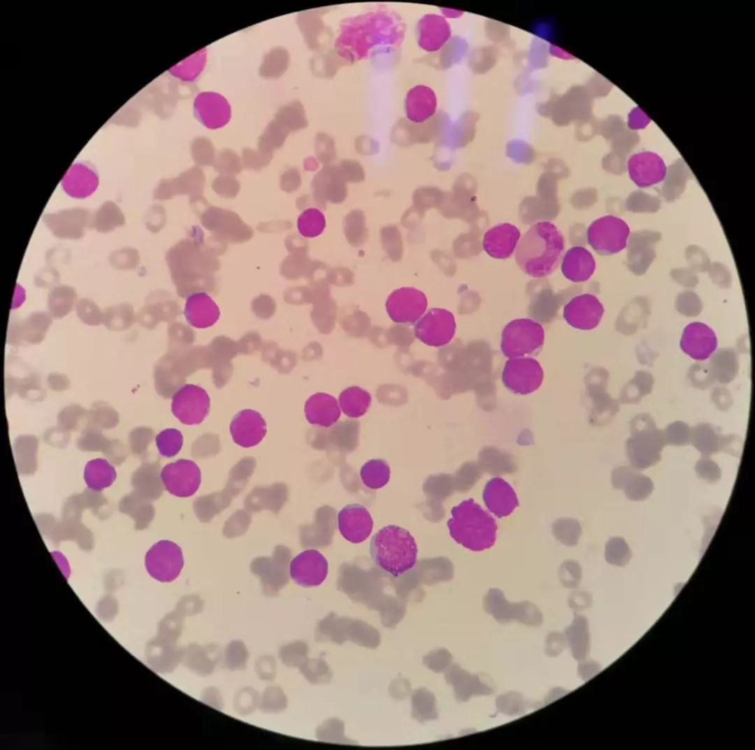 全血细胞减少就是白血病,全血细胞减少性白血病