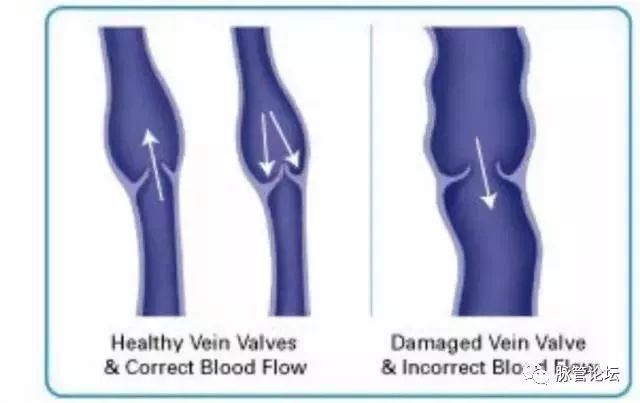 医生彻底根治静脉曲张的特效方法,广州中医治疗静脉曲张的10大忌