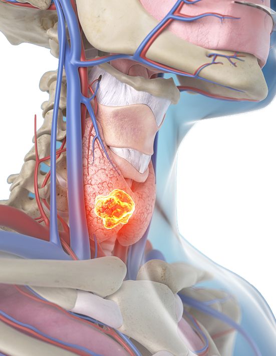 结节息肉囊肿哪个容易癌变,体检报告上结节囊肿息肉是癌症吗