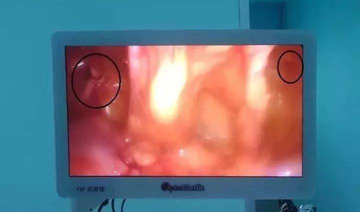 腹股沟疝传统术式最常用,疝气手术第二天需要做什么