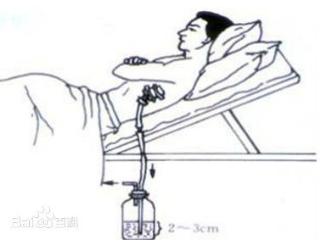 肺组织压缩约10%需要住院吗,肺组织压缩50%复发可能性