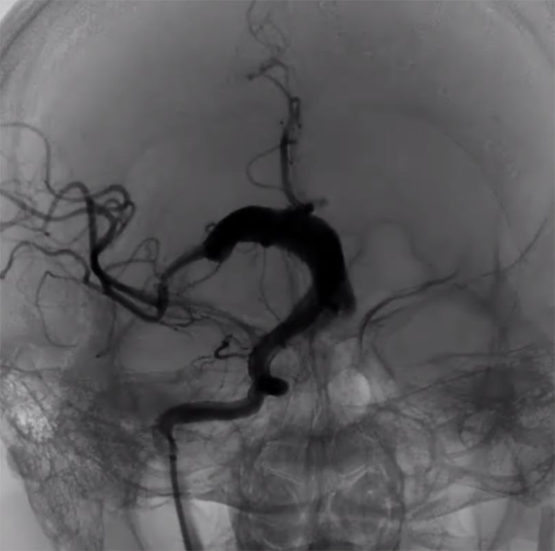 物华天宝·第7期｜脑部长型巨大夹层动脉瘤的4个密网支架桥接治疗复查治愈（附复查CTA结果）