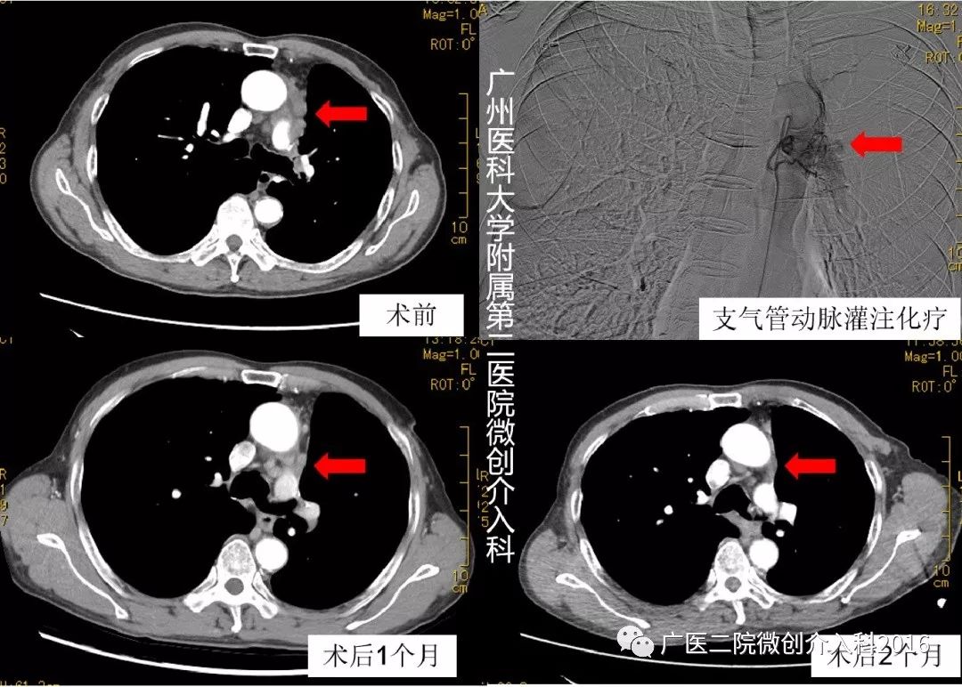 精准介入治疗效果好吗,精准免疫治疗最新消息