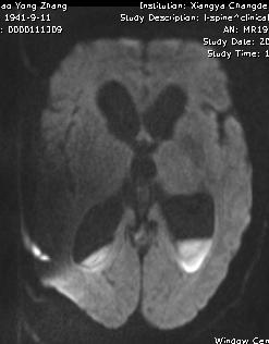 Rasmussen脑炎、结核性肉芽肿、脑发育性静脉畸形丨3分钟读片·第13期,下)