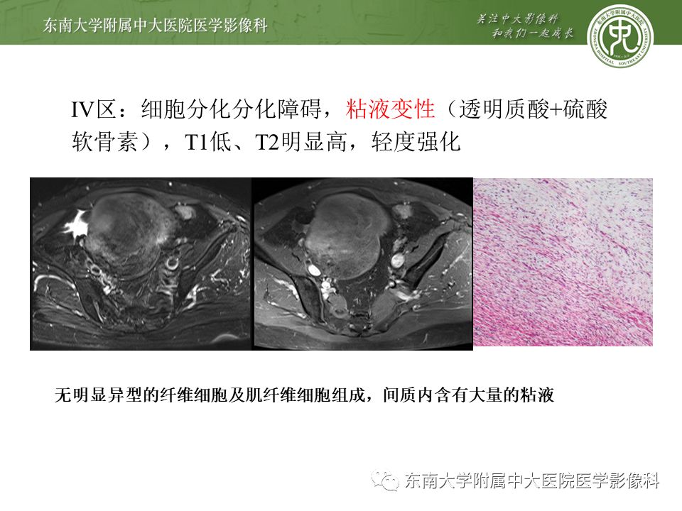 侵袭性纤维瘤影像学表现,侵袭性纤维瘤病影像上易诊断吗
