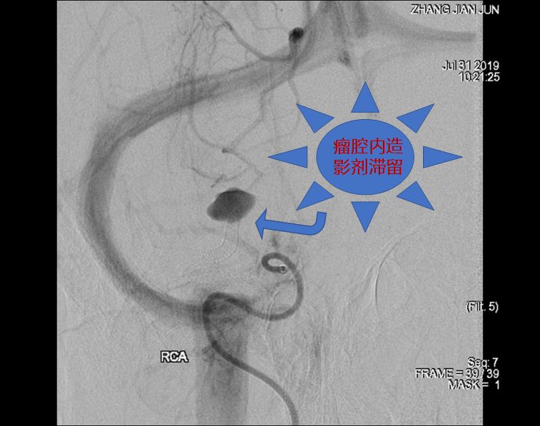 治疗颅内动脉瘤新型密网支架,密网支架处理动脉瘤的风险