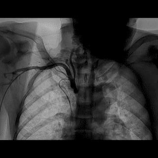 冠脉造影技术成熟不,跟我学技术分析从入门到精通