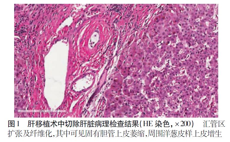 硬化性胆管炎igg4正常吗,igg4相关性硬化性胆管炎诊疗进展