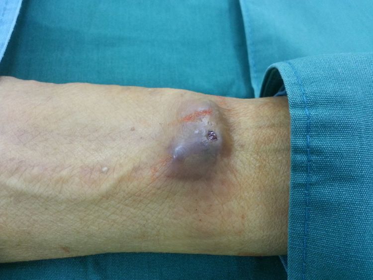 血透动静脉内瘘手术三种术式图解,血透室动静脉内瘘穿刺及护理