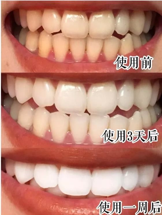 去除黄牙牙垢的牙膏,去口臭黄牙牙垢的牙膏