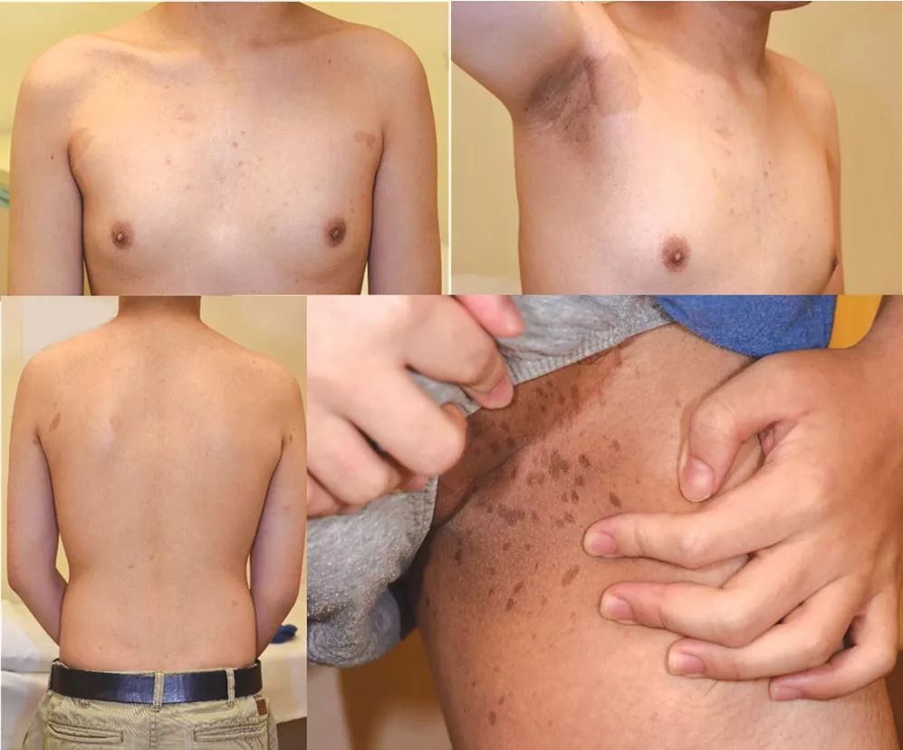 牛奶咖啡斑会导致哪些疾病,牛奶咖啡斑会导致什么疾病