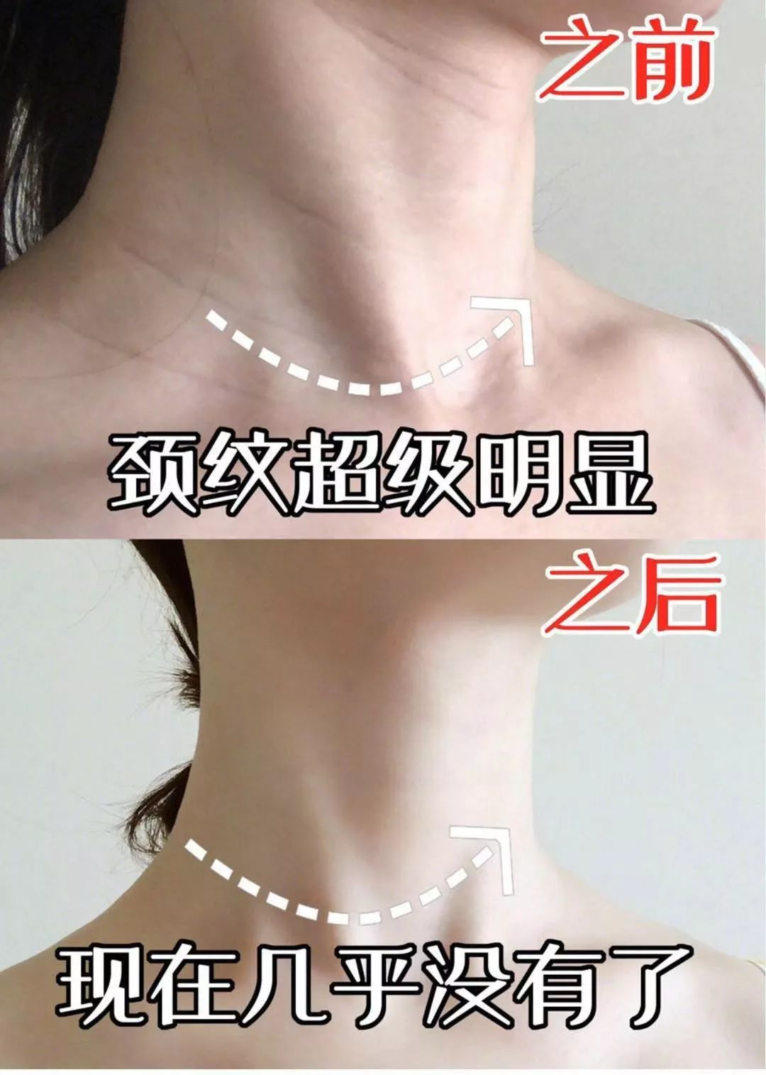 蛋白贴去皱,胶原蛋白颈纹贴