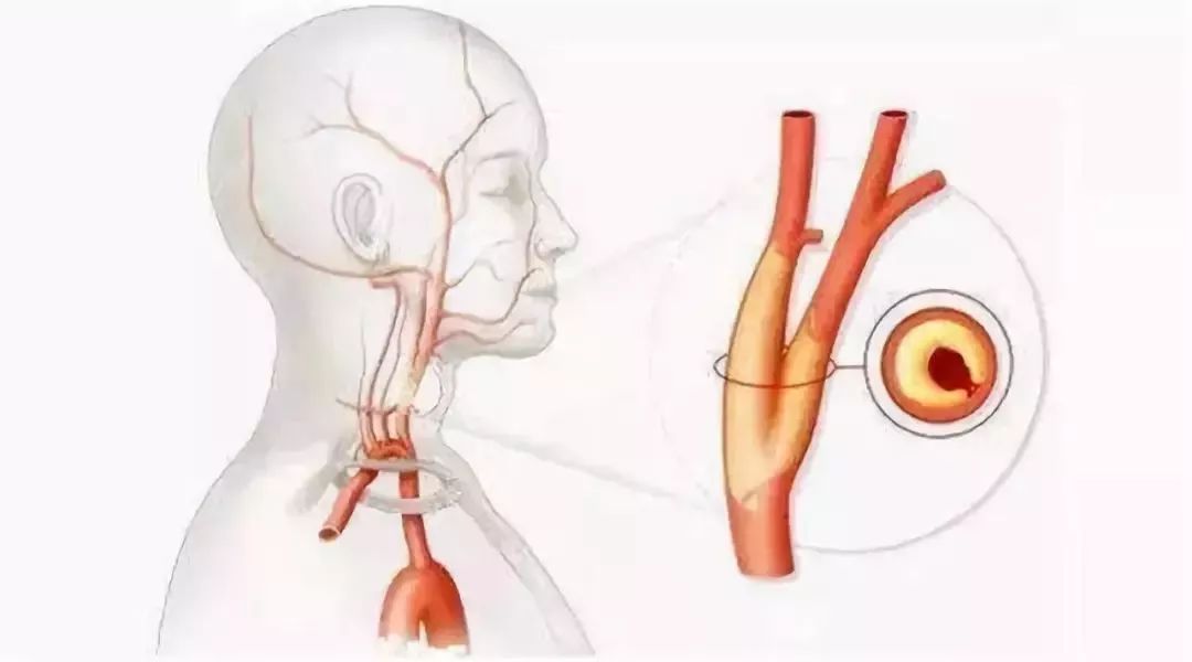体检发现颈动脉斑块得重视,体检发现颈动脉斑块需要复查吗