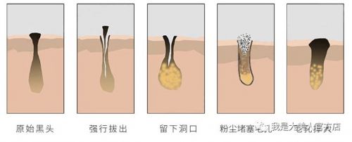 画面极度舒适！十几年顽固老黑头，30秒彻底连根拔起！毛孔畅快呼吸原来是这种感觉