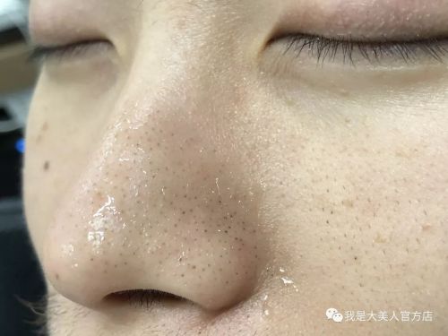 画面极度舒适！十几年顽固老黑头，30秒彻底连根拔起！毛孔畅快呼吸原来是这种感觉