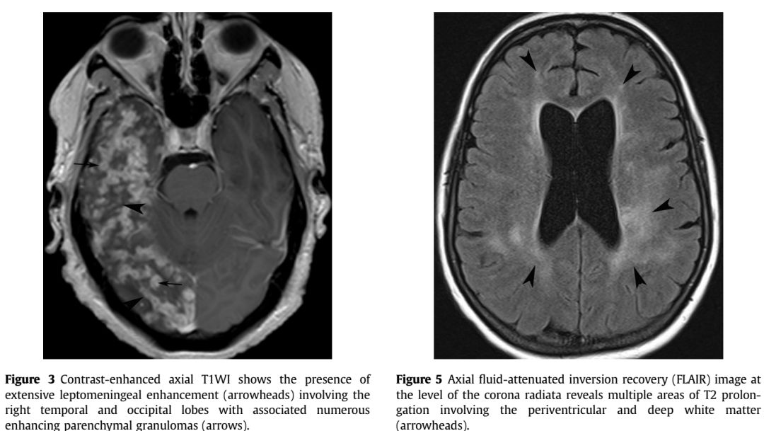Whipple病、纹状体手、神经结节病、脱髓鞘假瘤丨3分钟读片·第16期