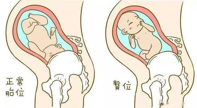 臀位如何阴道分娩?