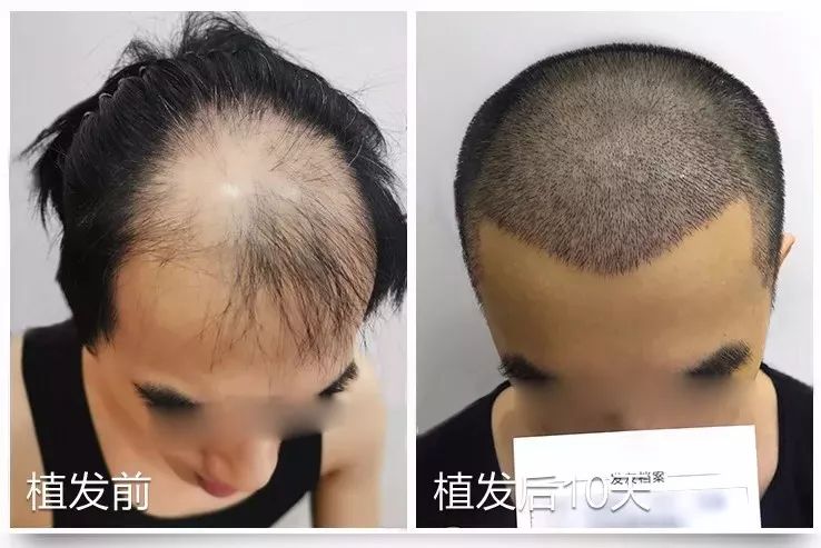 报道来了！28岁小伙“秃”成50岁？过年前抓紧……芜湖全面启动