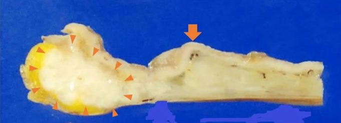 十二指肠腺癌累及胰腺算转移吗,罕见异位嗜铬细胞瘤1例